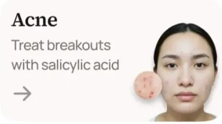 Acne, Marks & Scar Revision Protocol